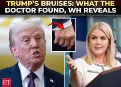 ‘Trump wanted transparency’: WH reveals shocking truth behind his swollen ankles & bruised hand